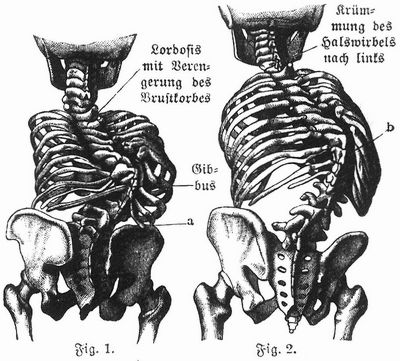 Fig. 1. Kyphosis der Wirbelsäule im Brust- und Lendenteil. a Durch Verkürzung der Wirbelsäule erreichen die Rippen den Darmdeinkanal. Fig. 2. Kypho-Skoliosis. b Kyphosis mit Abweichung nach rechts.