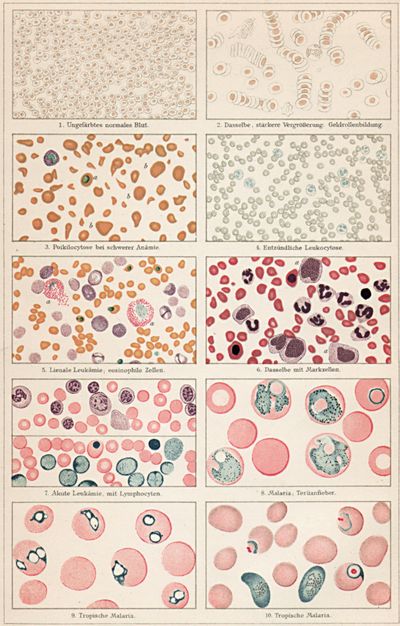 Blut und Blutbewegung I. Krankhafte Veränderungen des Blutes einschließlich Malariaparasiten.